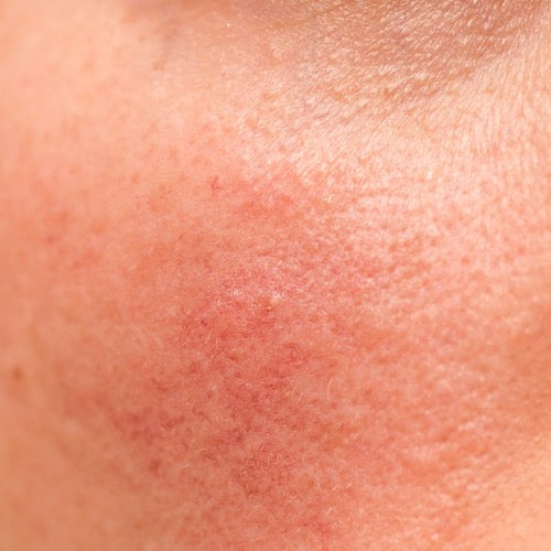 <h3><strong>Uneven Skin Tone Correction</strong></h3>